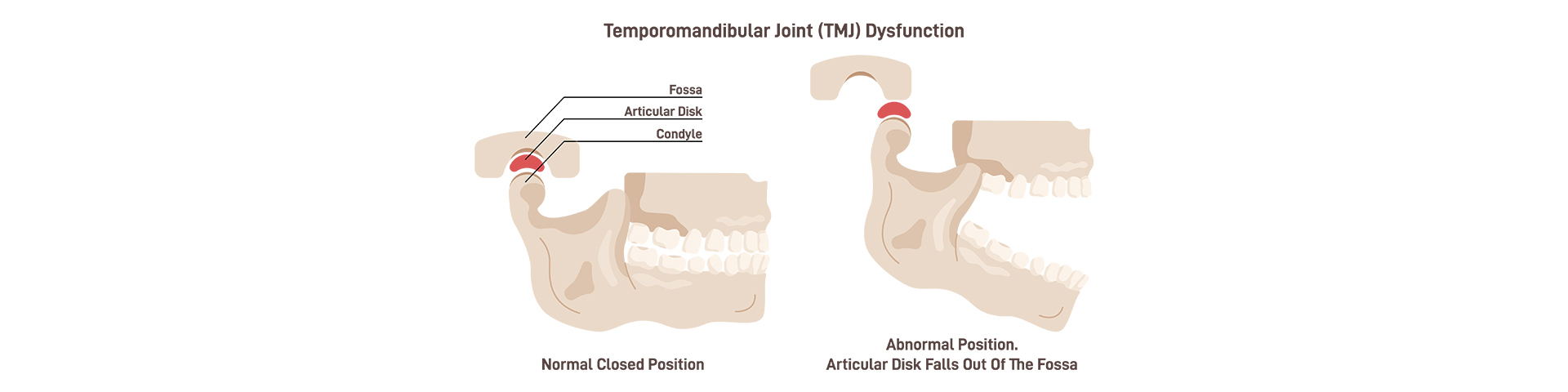 TMJ Treatment