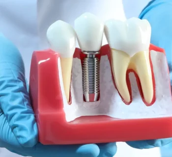 How Are Crowns Attached to Dental Implants?