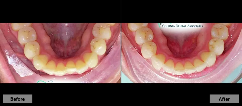 Before and After treatment images 48- Colonia Dental Associates