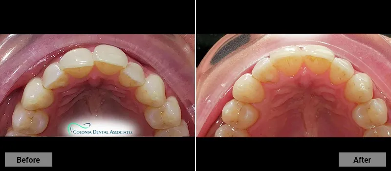 Before and After treatment images 42- Colonia Dental Associates