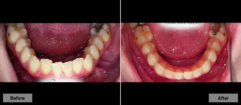 Before and After treatment images 21- Colonia Dental Associates