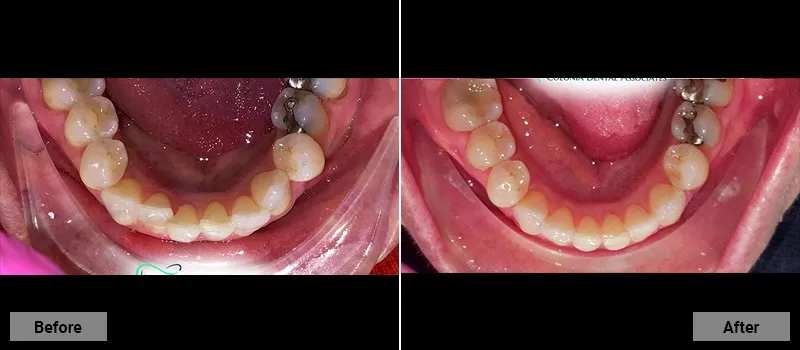 Before and After treatment images 30- Colonia Dental Associates