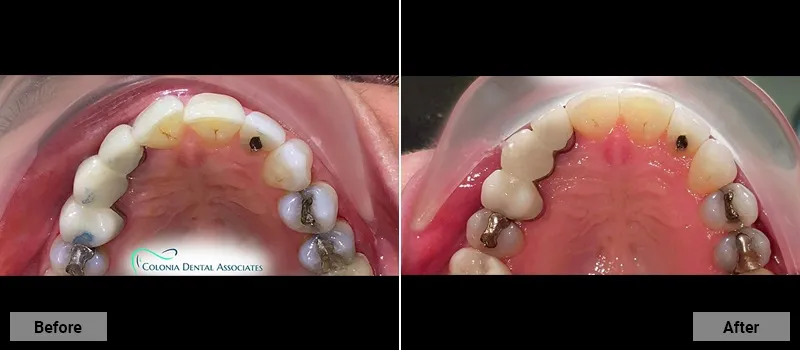 Before and After treatment images 16- Colonia Dental Associates