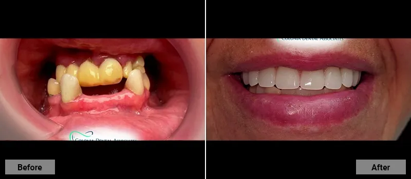 Before and After treatment images 4- Colonia Dental Associates