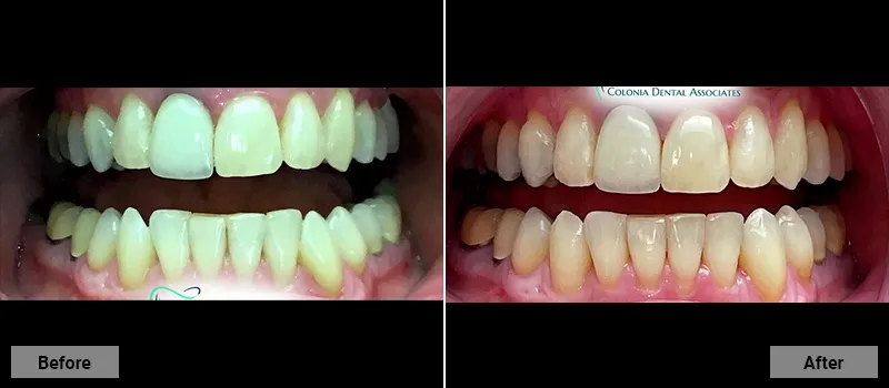 Before and After treatment images 69- Colonia Dental Associates
