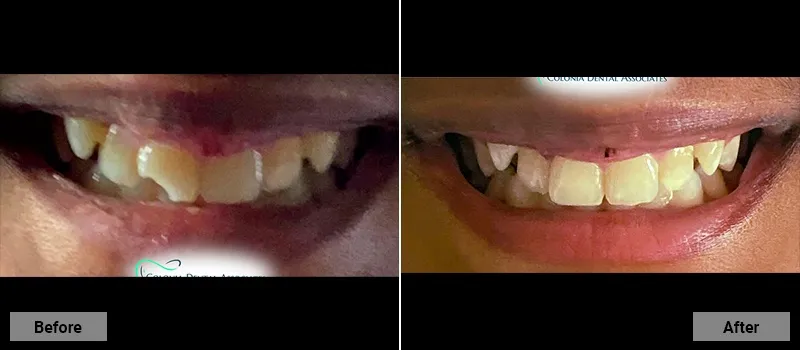 Before and After treatment images 57- Colonia Dental Associates