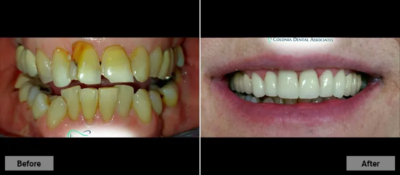 Before and After treatment images 66- Colonia Dental Associates