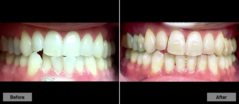 Before and After treatment images 53- Colonia Dental Associates