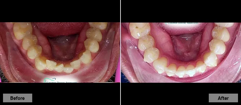 Before and After treatment images 45- Colonia Dental Associates