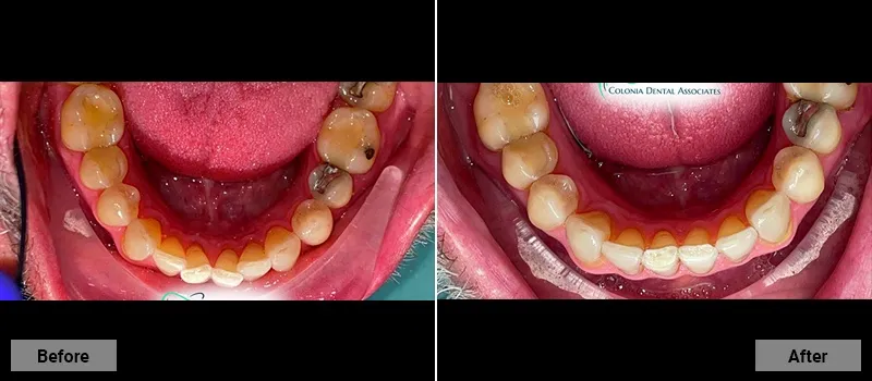 Before and After treatment images 39- Colonia Dental Associates