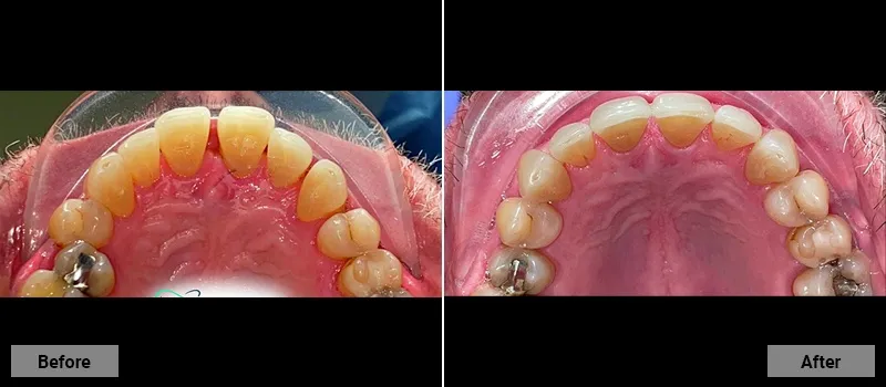 Before and After treatment images 9- Colonia Dental Associates