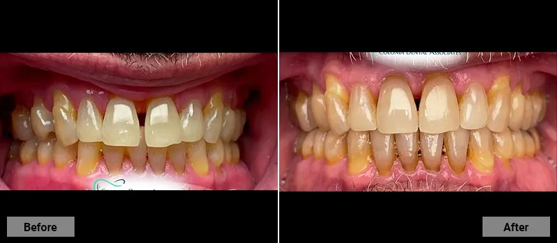 Before and After treatment images 3- Colonia Dental Associates