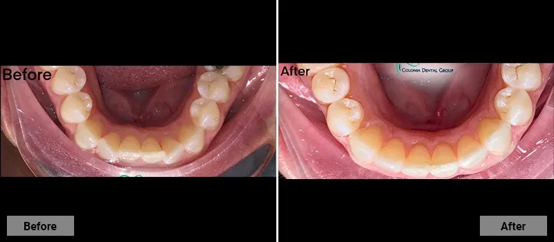 Before and After treatment images 10- Colonia Dental Associates