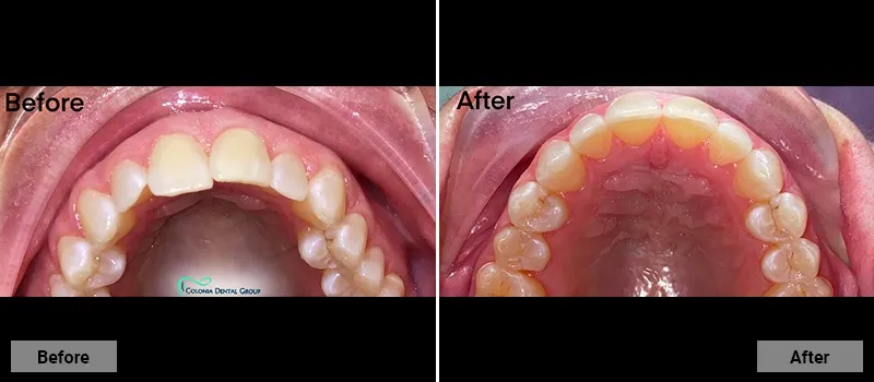 Before and After treatment images 33- Colonia Dental Associates