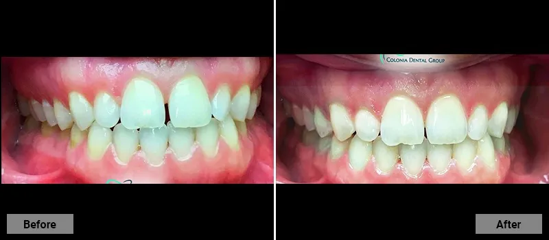 Before and After treatment images 23- Colonia Dental Associates