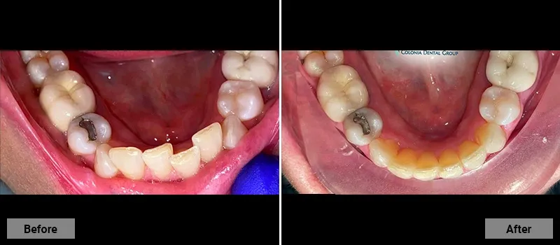 Before and After treatment images 47- Colonia Dental Associates