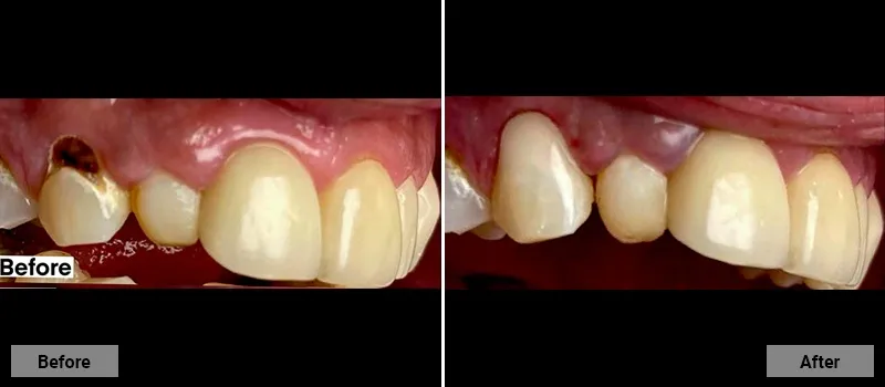 Before and After treatment images 43- Colonia Dental Associates