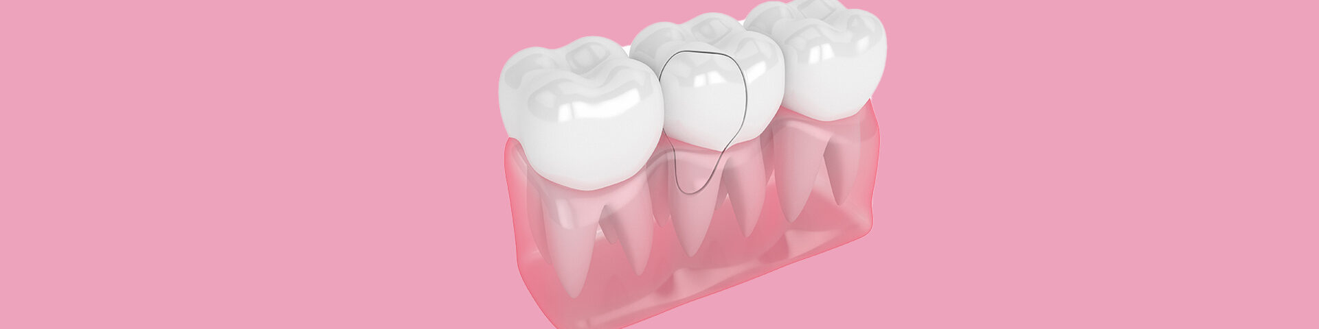 Can You Save a Damaged Tooth? When Extraction Is the Best Option