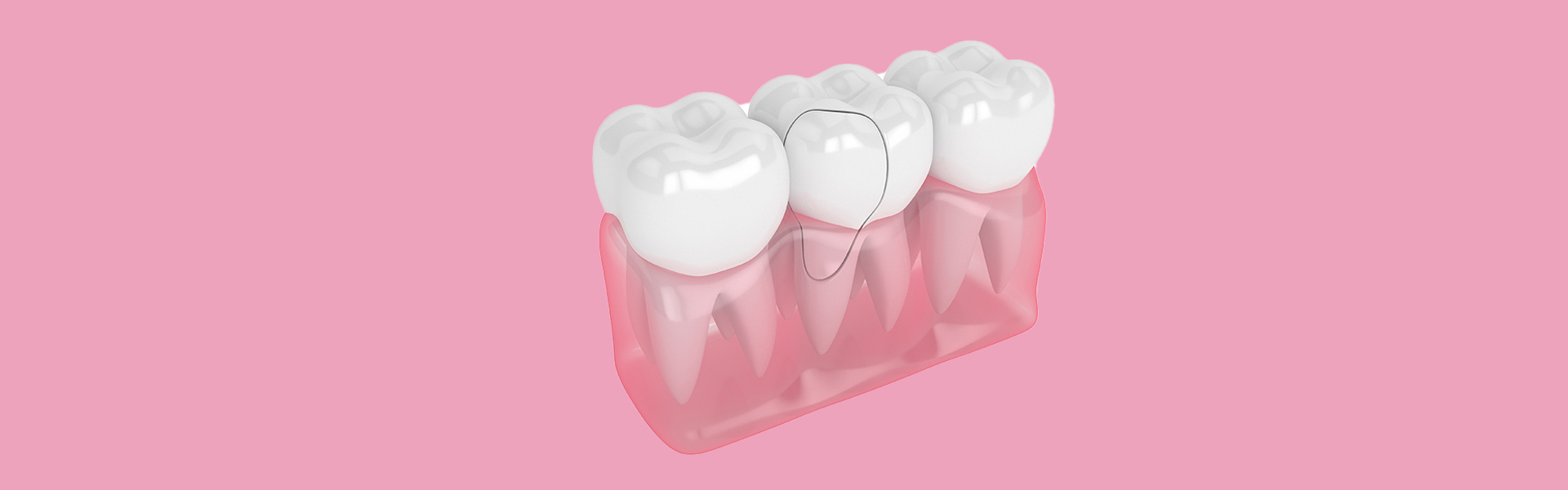 Can You Save a Damaged Tooth? When Extraction Is the Best Option
