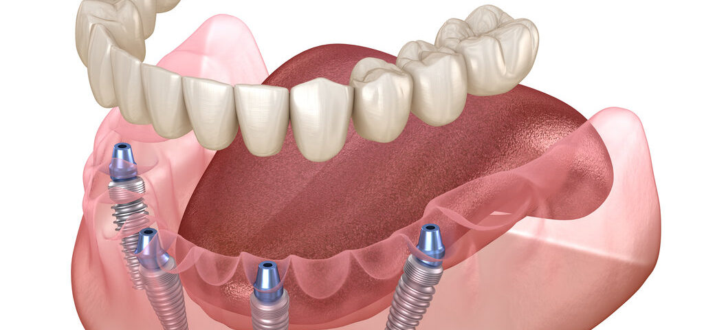 All-on-4 Implants: A Complete Guide for Woodbridge Area Patients