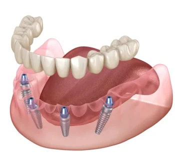 All-on-4 Implants: A Complete Guide for Woodbridge Area Patients