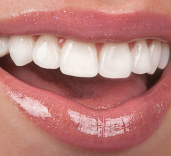 Smile Makeovers: How Veneers Can Transform Your Confidence in Just a Few Visits