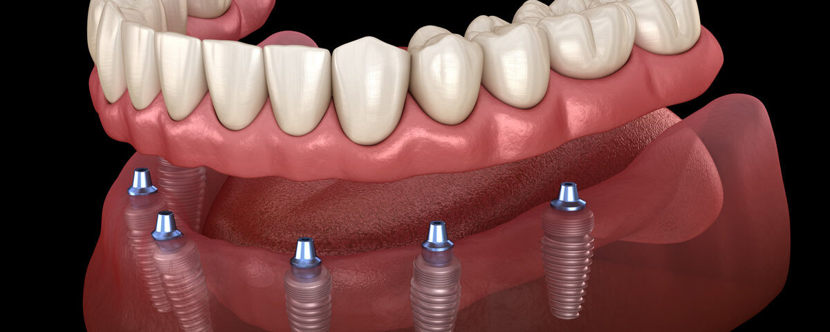 Implant-Supported Dentures: A Stable Solution for Missing Teeth