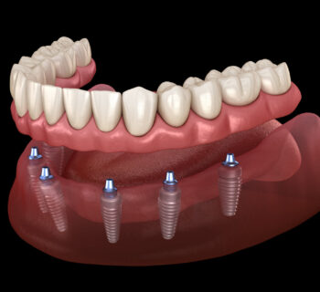 Implant-Supported Dentures: A Stable Solution for Missing Teeth