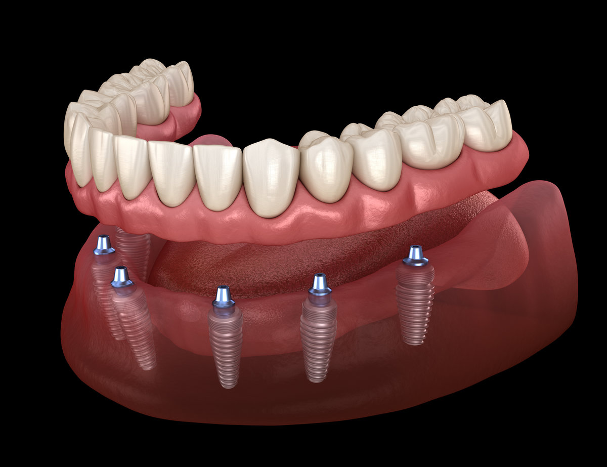 Implant-Supported Dentures: A Stable Solution for Missing Teeth