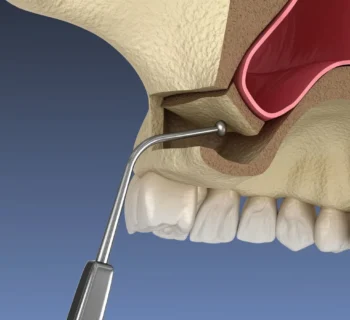 Sinus Lifts and Bone Grafting: Advanced Implant Solutions for Complex Cases