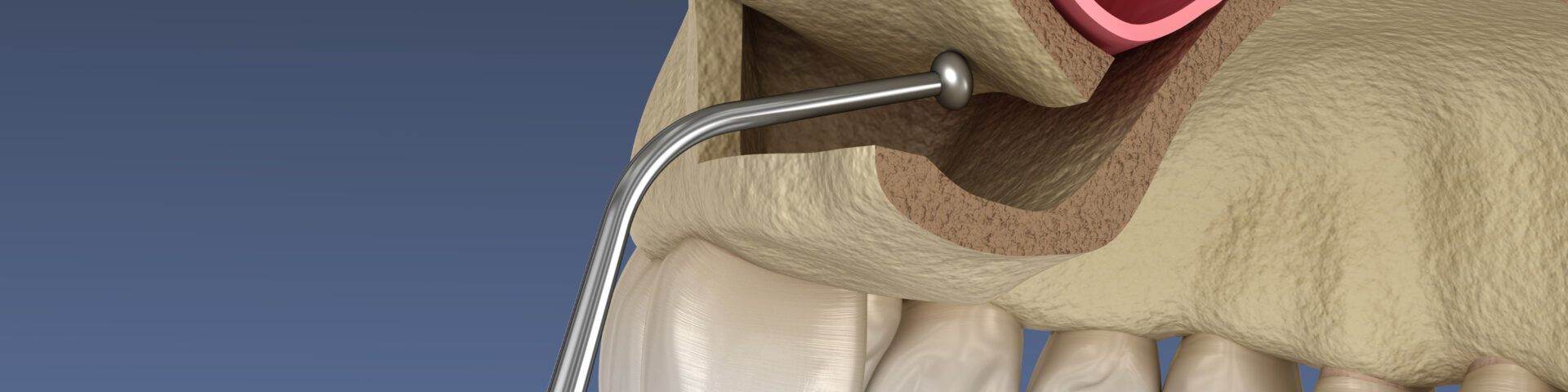 How Sinus Lifts Make Upper Jaw Implants Possible in Woodbridge