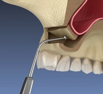 How Sinus Lifts Make Upper Jaw Implants Possible in Woodbridge