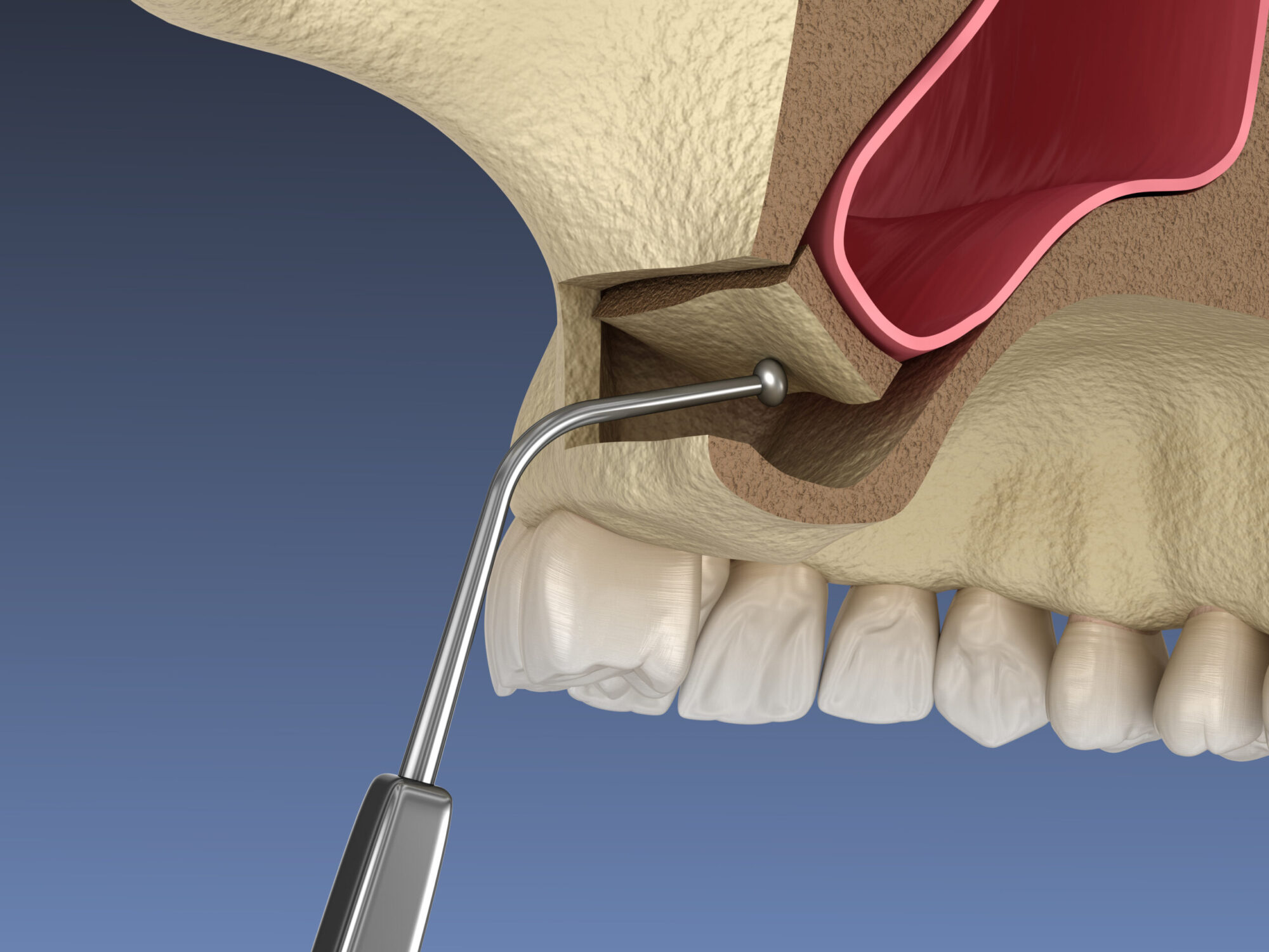How Sinus Lifts Make Upper Jaw Implants Possible in Woodbridge