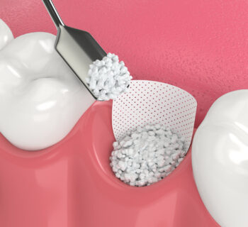 Bone Grafting in Colonia, NJ