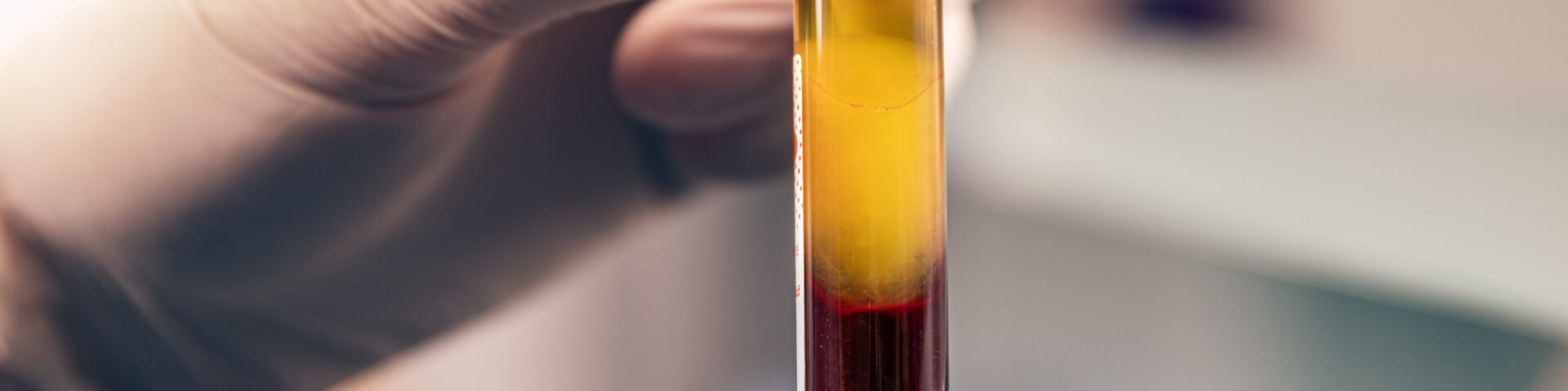 Why You Should Switch from Dermal Filler to PRF