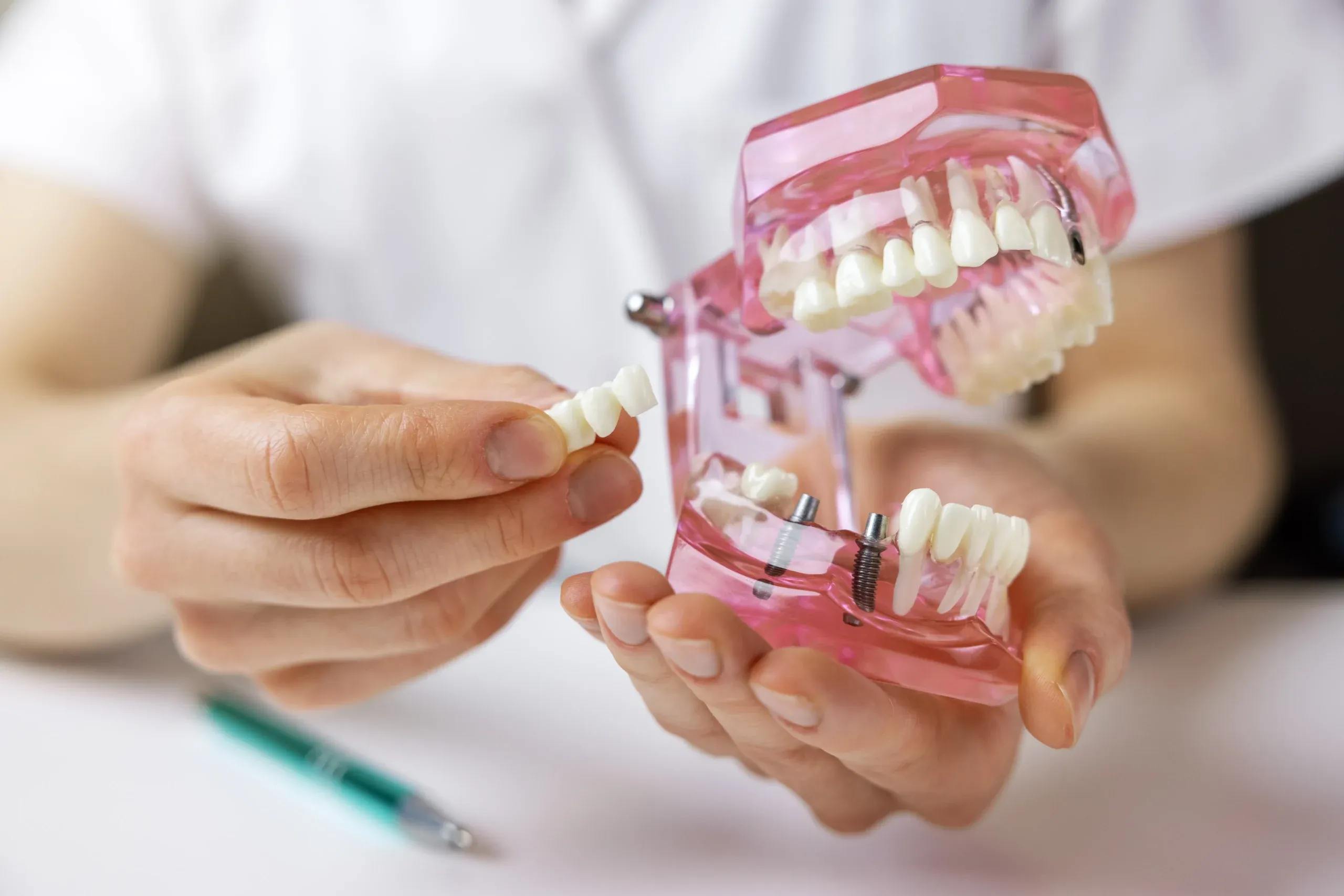All-on-4 vs. Traditional Dental Implants: Which Full Arch Solution is Right for You?