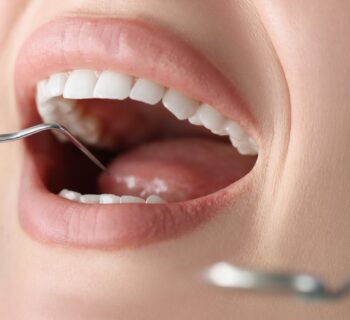 Porcelain Veneers vs. Composite Bonding Your Smile Actually Needs